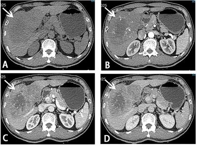 Case Report: Hepatic Artery Infusion Chemotherapy After Stage I ALPPS in a Patient With Huge HCC
